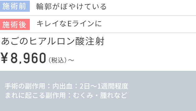 CASE2 ヒアルロン酸注射の価格