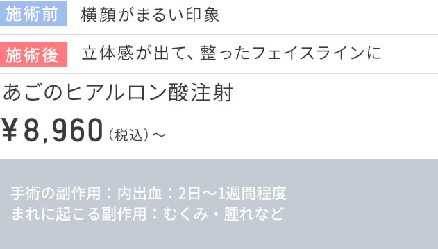 CASE3 ヒアルロン酸注射の価格