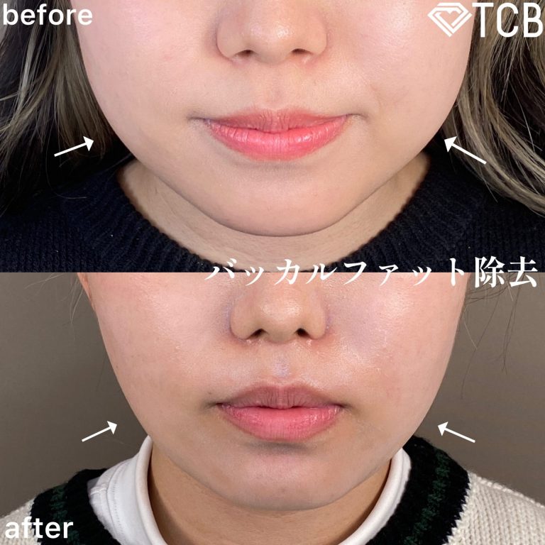 小顔の症例写真