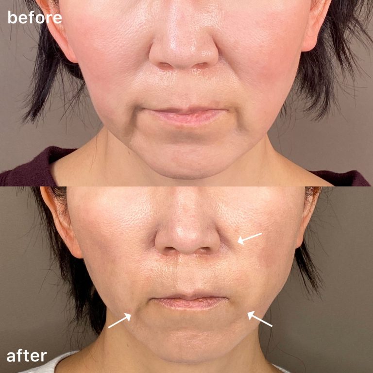 小顔の症例写真