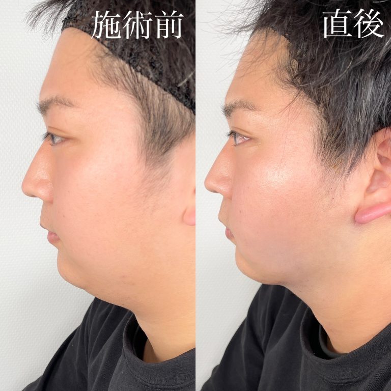 小顔の症例写真