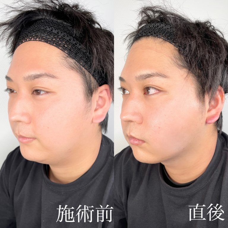 小顔の症例写真