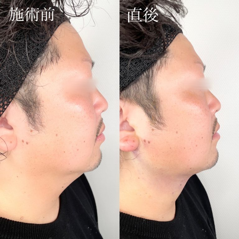 小顔の症例写真