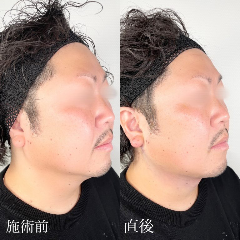 小顔の症例写真