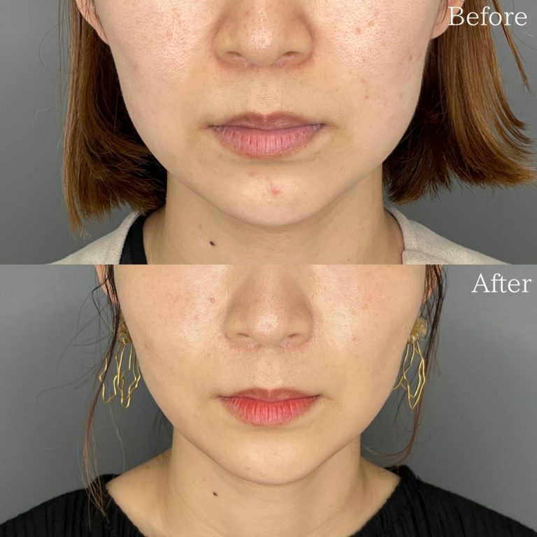 小顔の症例写真