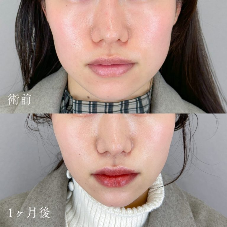 小顔の症例写真