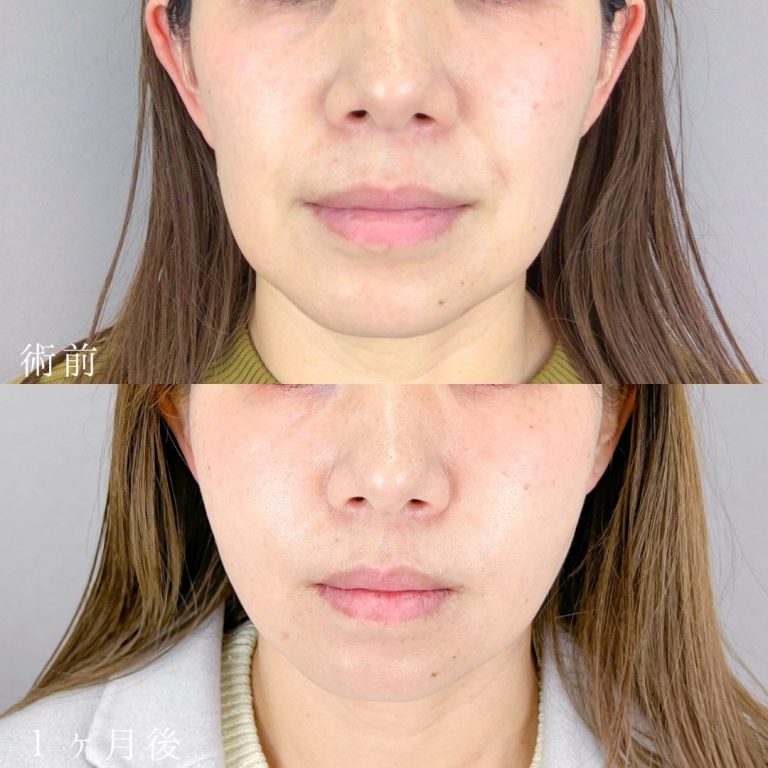 小顔の症例写真