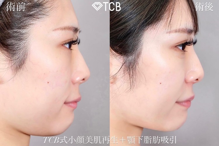 小顔の症例写真