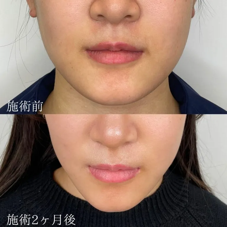小顔の症例写真
