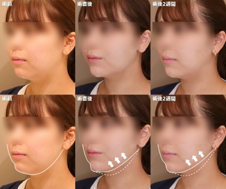 小顔脂肪吸引クイックの経過写真