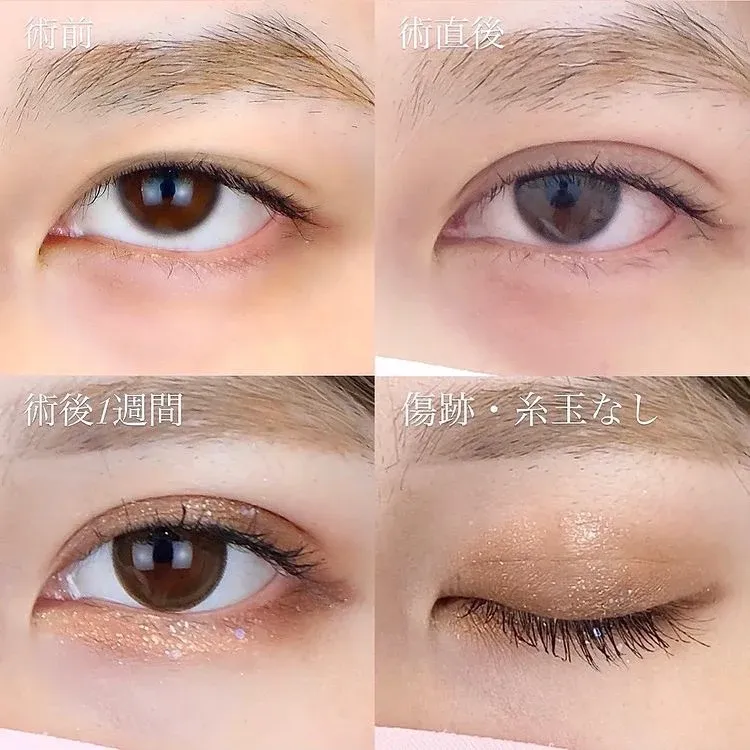 二重整形の症例写真