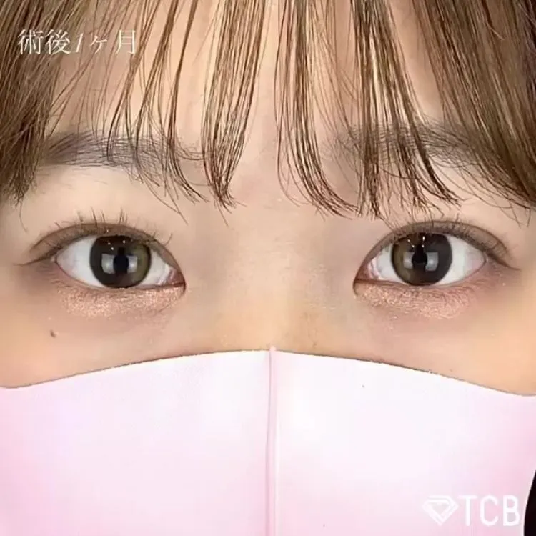 二重整形の症例写真