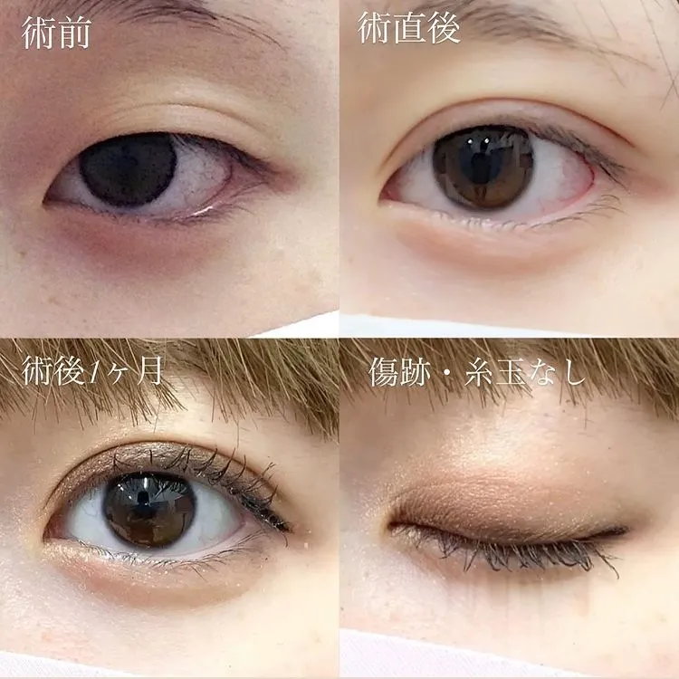 二重整形の症例写真