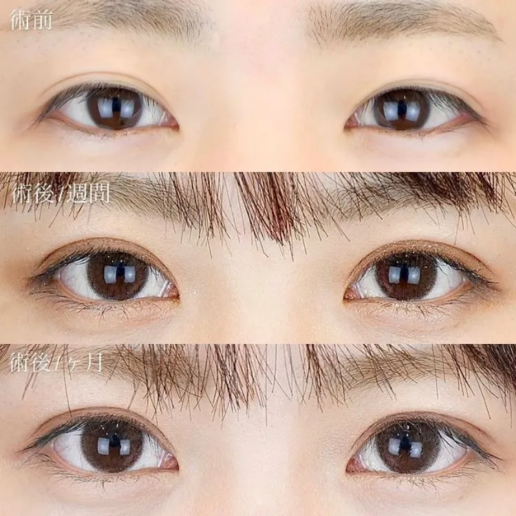 二重整形の症例写真