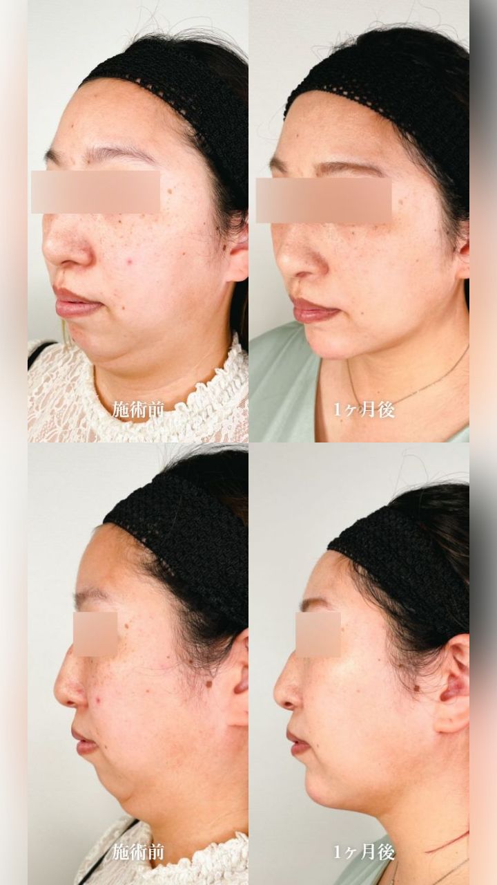 小顔施術「顔の脂肪吸引」の症例写真