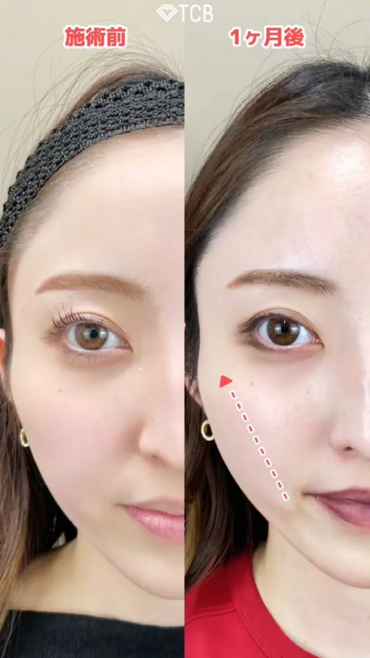 小顔施術「TCB小顔リフト」の症例写真