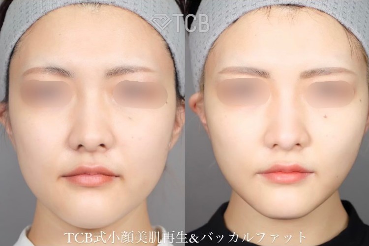 小顔施術「TCB小顔リフト」の症例写真