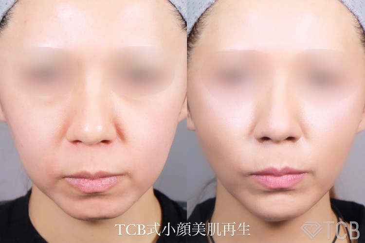 小顔施術「TCB小顔リフト」の症例写真