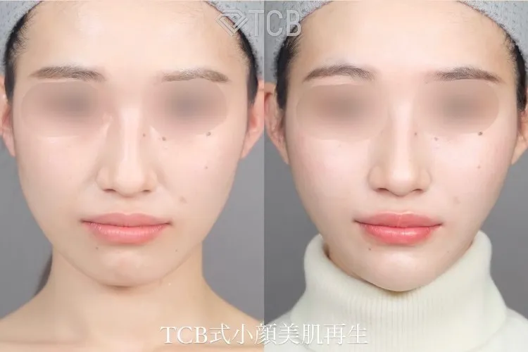 小顔施術「TCB小顔リフト」の症例写真