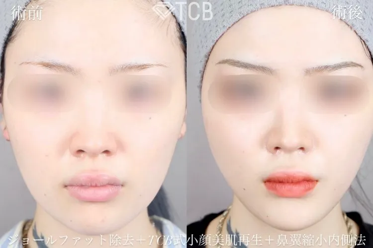 小顔施術「TCB小顔リフト」の症例写真