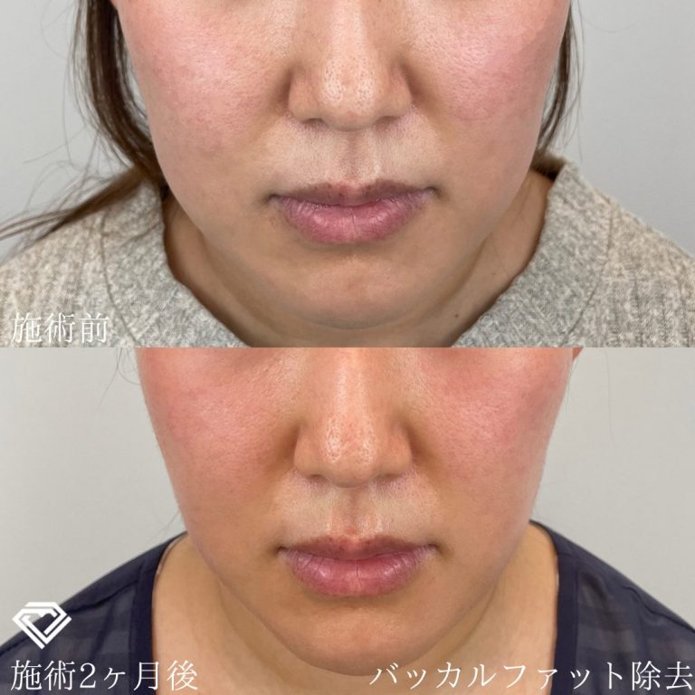 小顔施術「脂肪除去」の症例写真