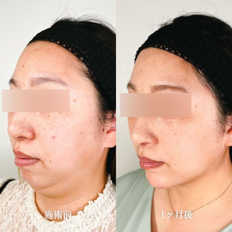 小顔施術「顔の脂肪吸引」の症例写真