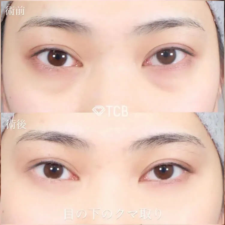 目の下のクマ取り施術の症例写真