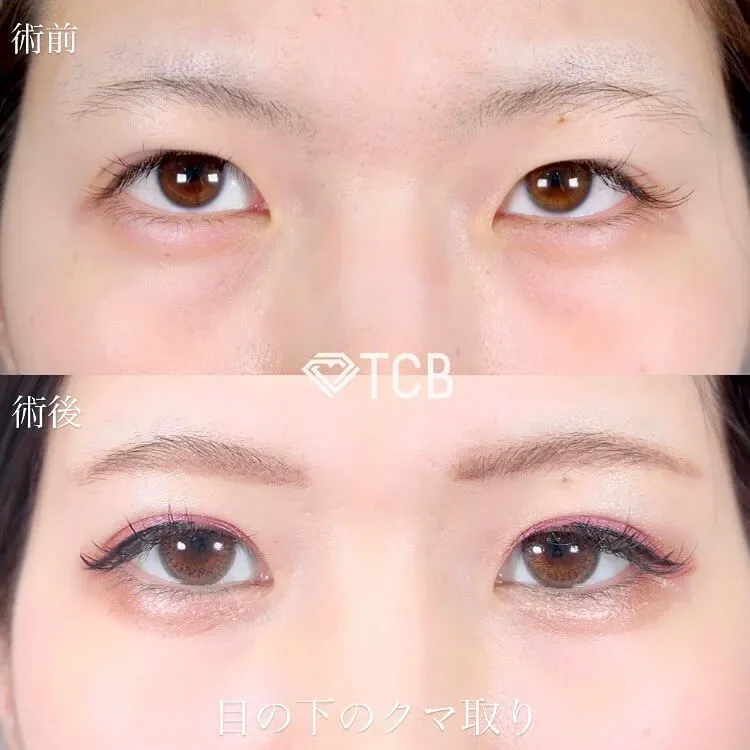 目の下のクマ取り施術の症例写真