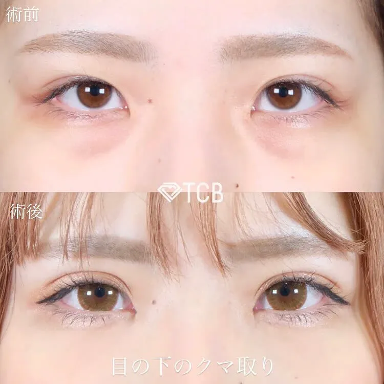 目の下のクマ取り施術の症例写真