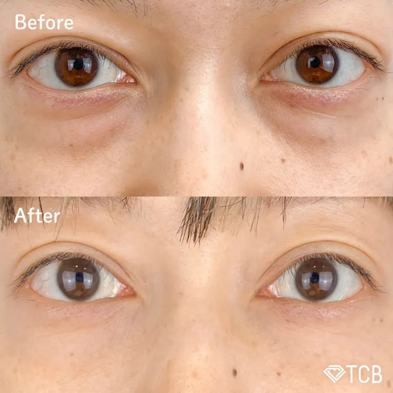 目の下のクマ取り施術の症例写真