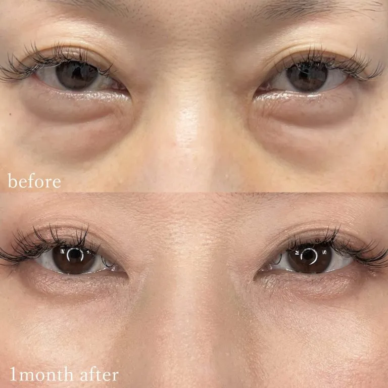 目の下のクマ取り施術の症例写真