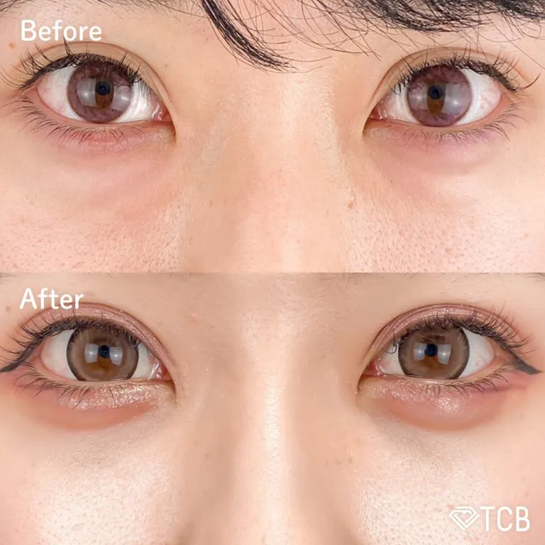 目の下のクマ取り施術の症例写真