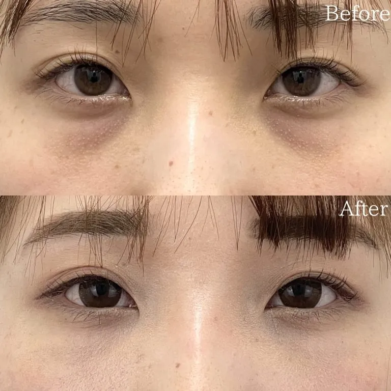 目の下のクマ取り施術の症例写真