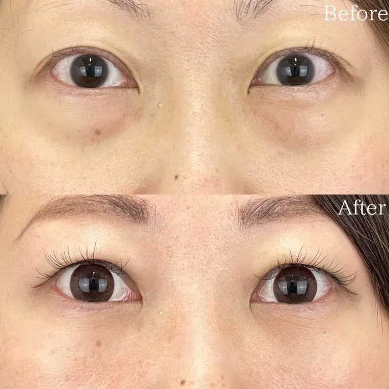 目の下のクマ取り施術の症例写真