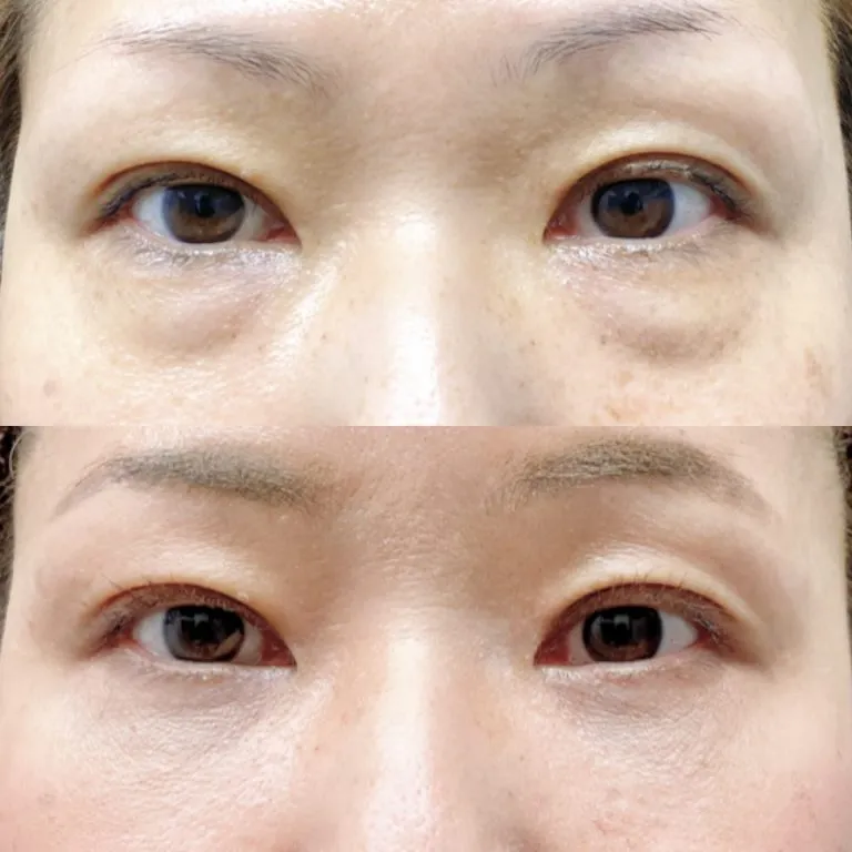 目の下のクマ取り施術の症例写真