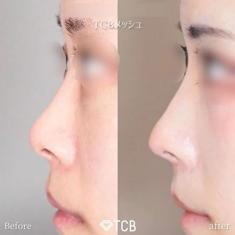 鼻施術の症例写真