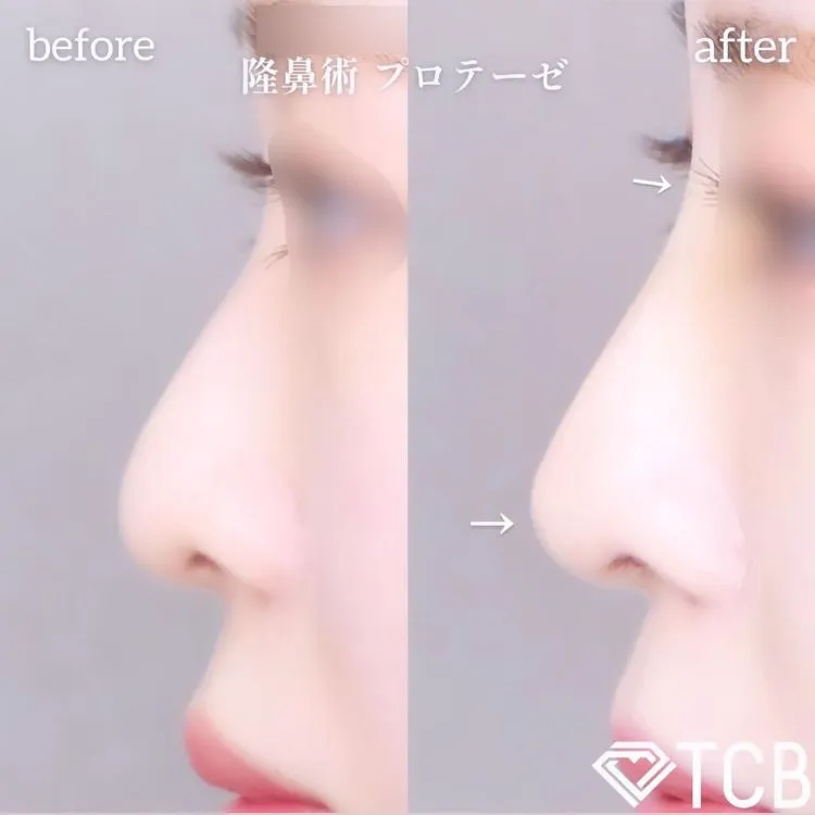 鼻施術の症例写真