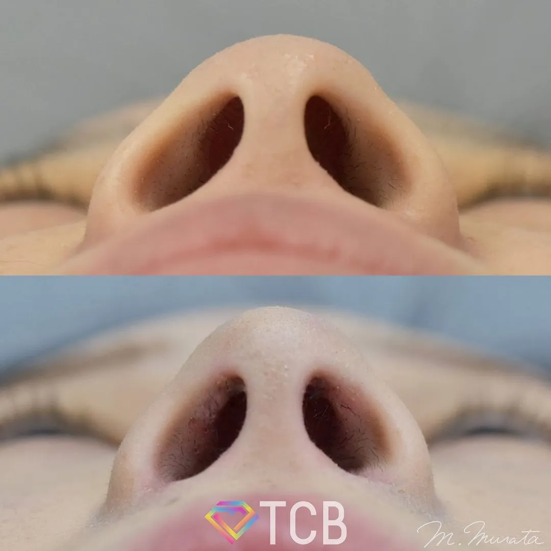 鼻施術の症例写真