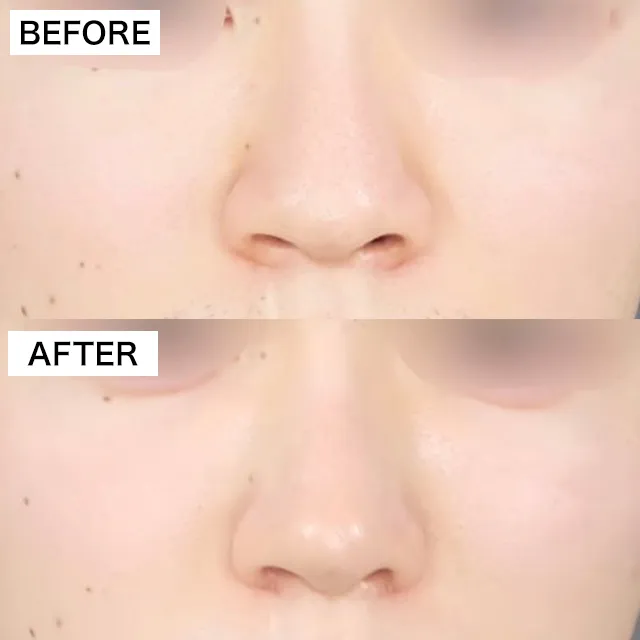鼻施術の症例写真