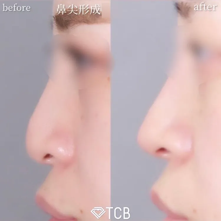鼻施術の症例写真