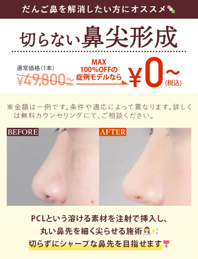 切らない鼻尖形成