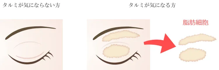 まぶたの切除法も同時に手術できる