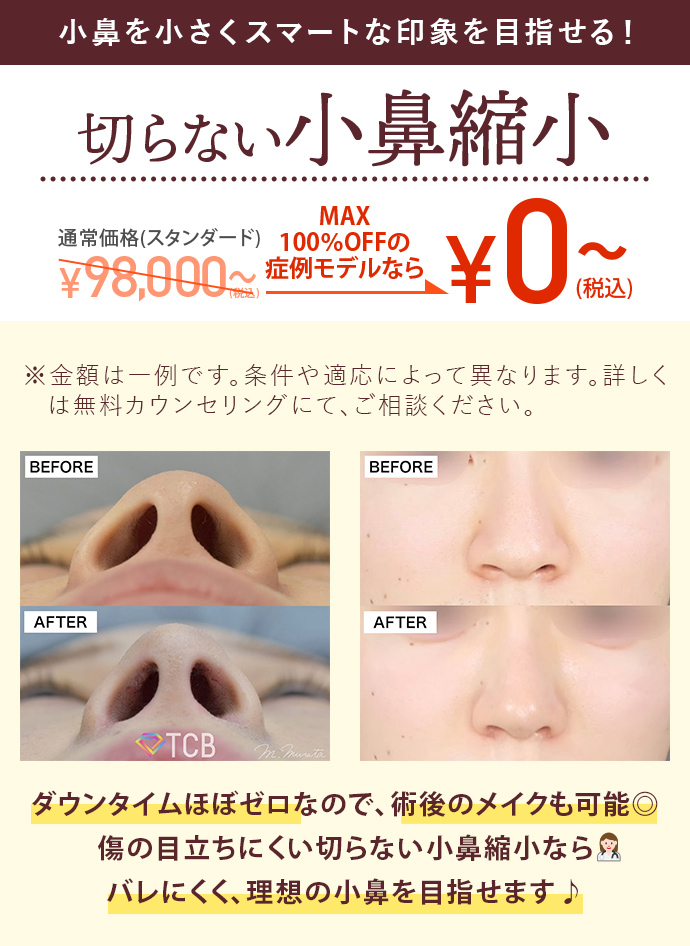 切らない小鼻縮小