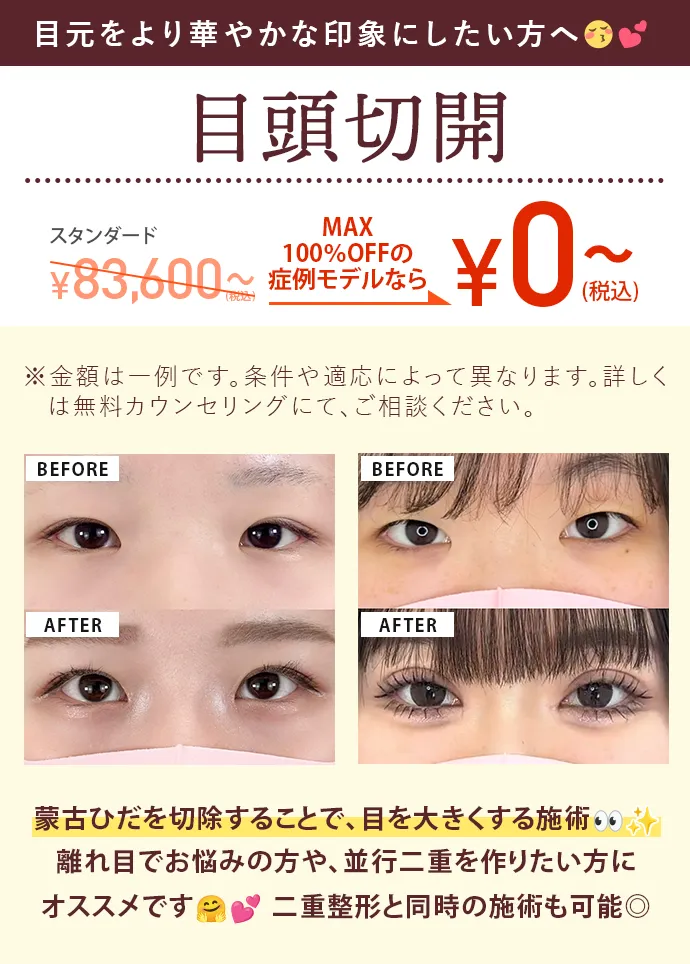目頭切開