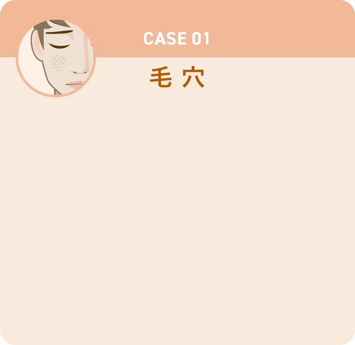 CASE01 毛穴