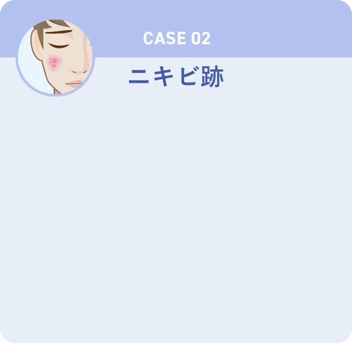 CASE02 ニキビ跡