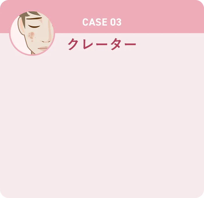CASE03 クレーター