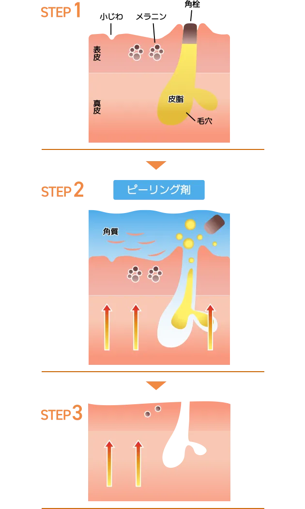 サリチル酸ピーリング・イラスト