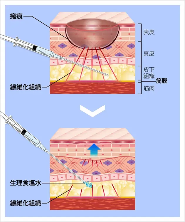 皮膚組織イラスト