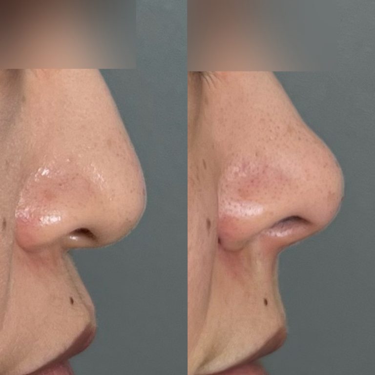 鼻の症例写真